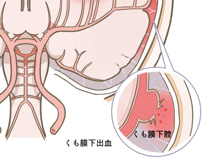 下 出血 前兆 期間 くも膜